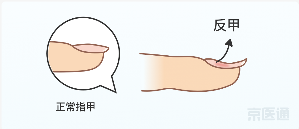 指甲上没月牙,有横线,长倒刺,是身体出问题了吗 健康保健 华源医药
